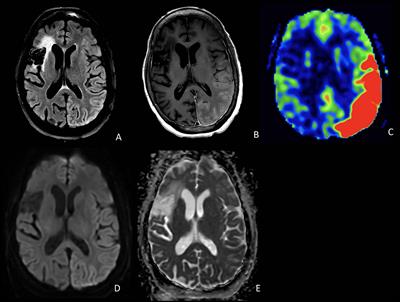 Case report: Neuronal intranuclear inclusion disease presenting with acute encephalopathy